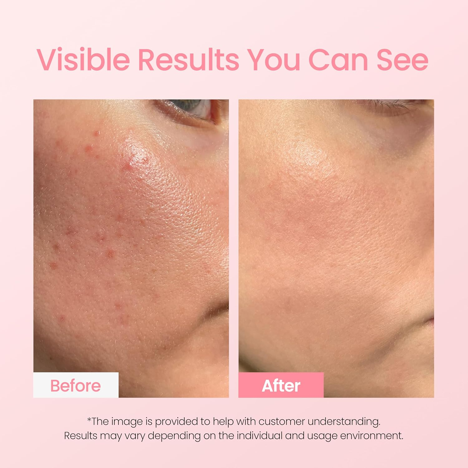 NEOGEN Dermalogy A-Clear Aid Soothing Pink Eraser (15ml)